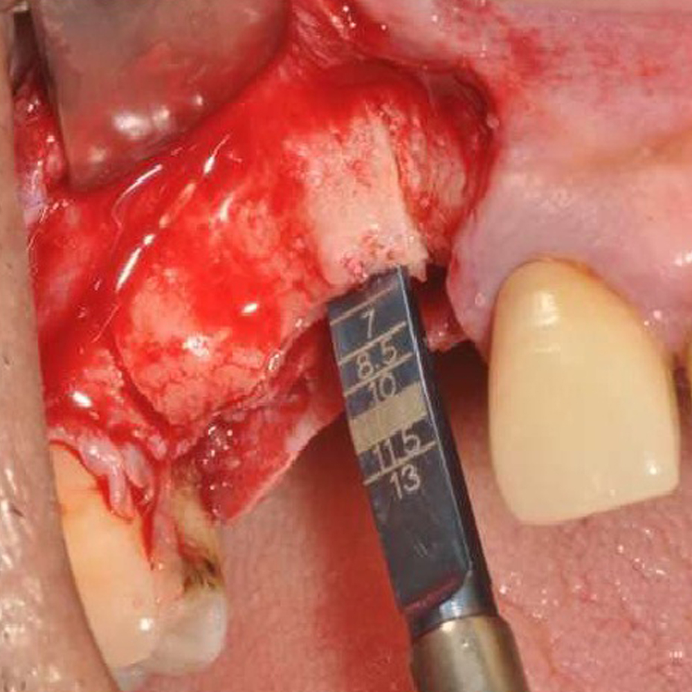 Julldent 014 Ridge Splitting Chisel Offset - Image 3