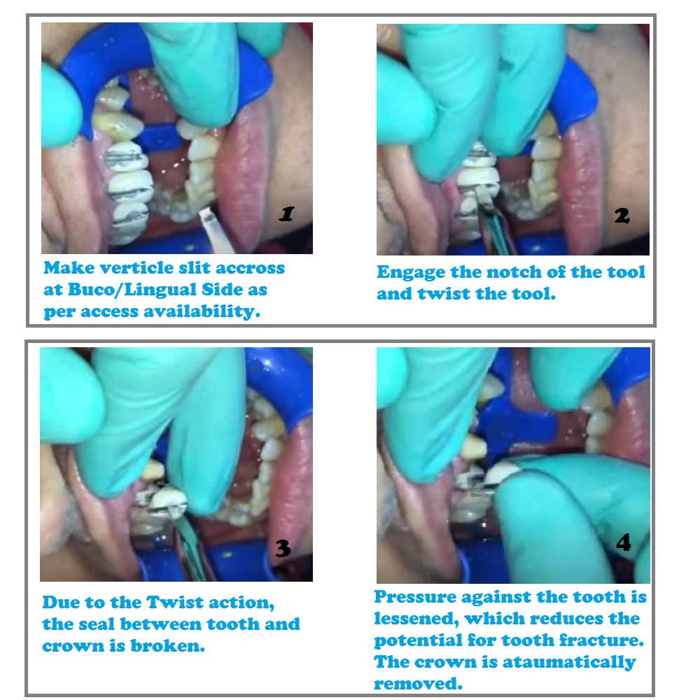 Julldent 071 Crown Remover (Christensen Design) - Image 2