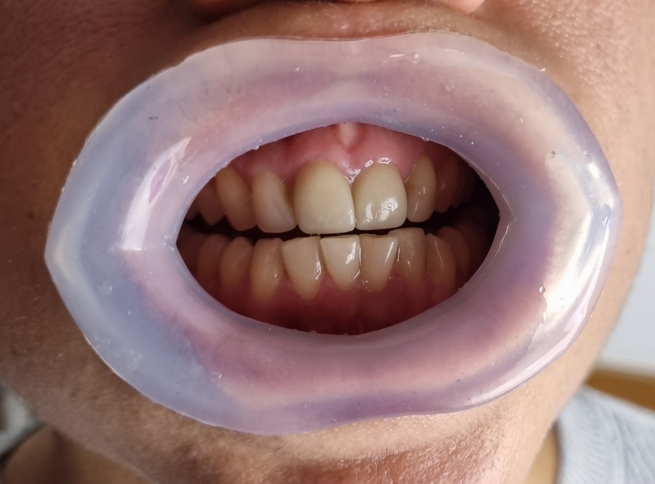 Julldent 144 Insta Retractor - Image 15