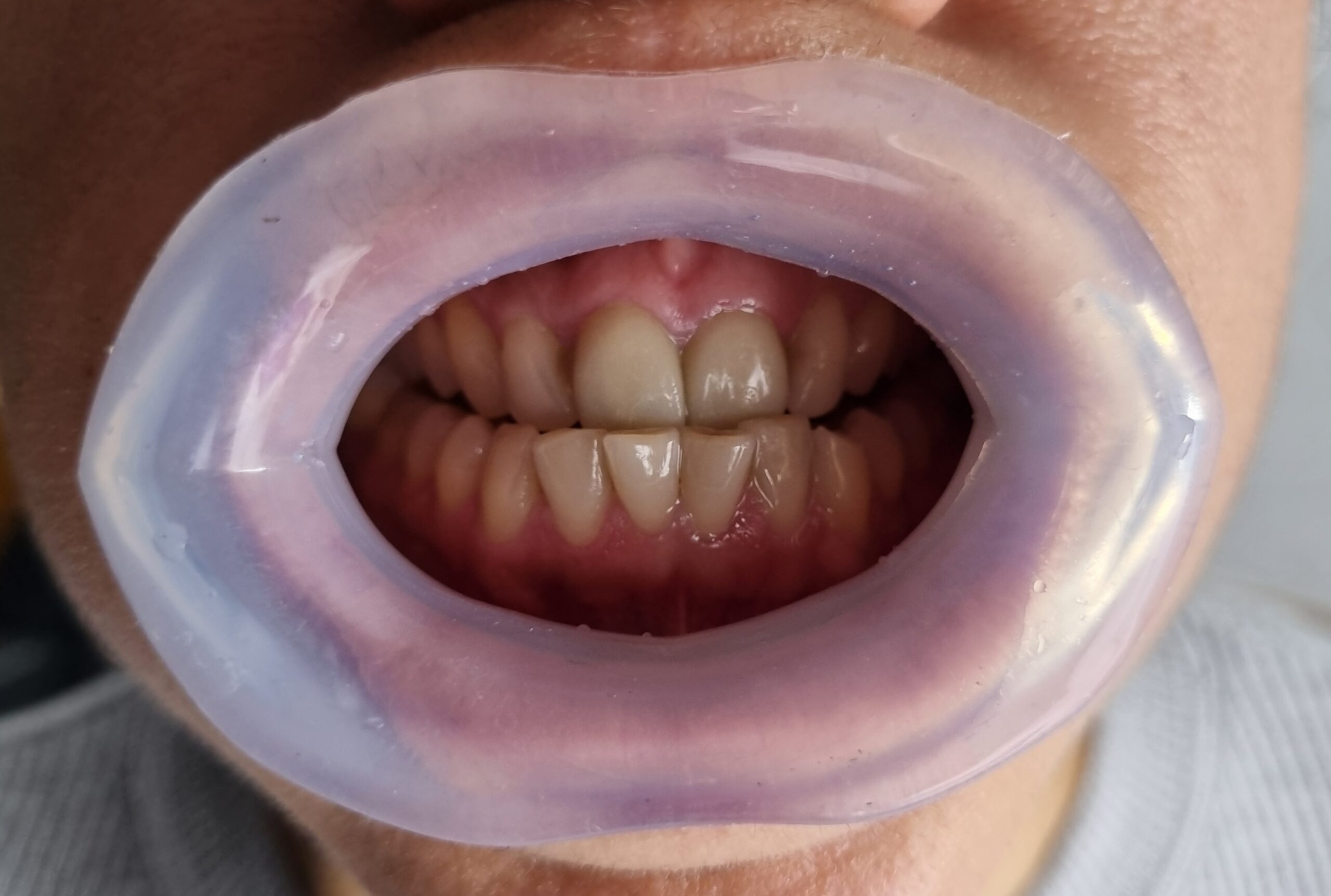 Julldent 144 Insta Retractor - Image 13