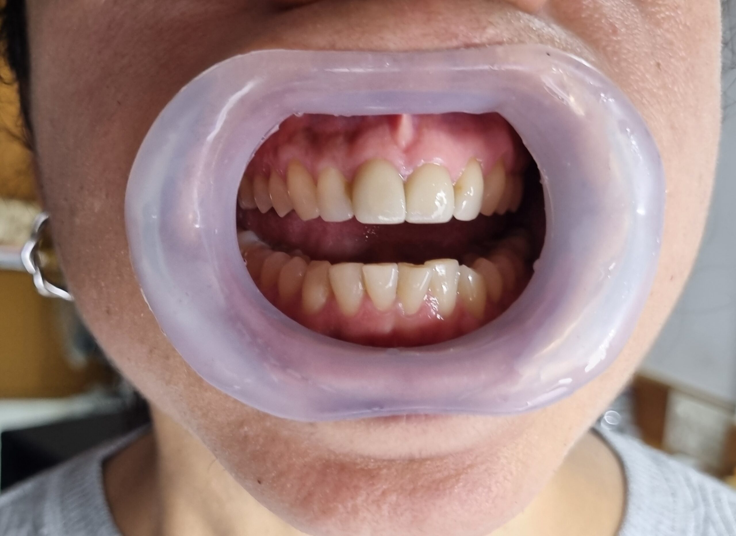 Julldent 144 Insta Retractor - Image 17