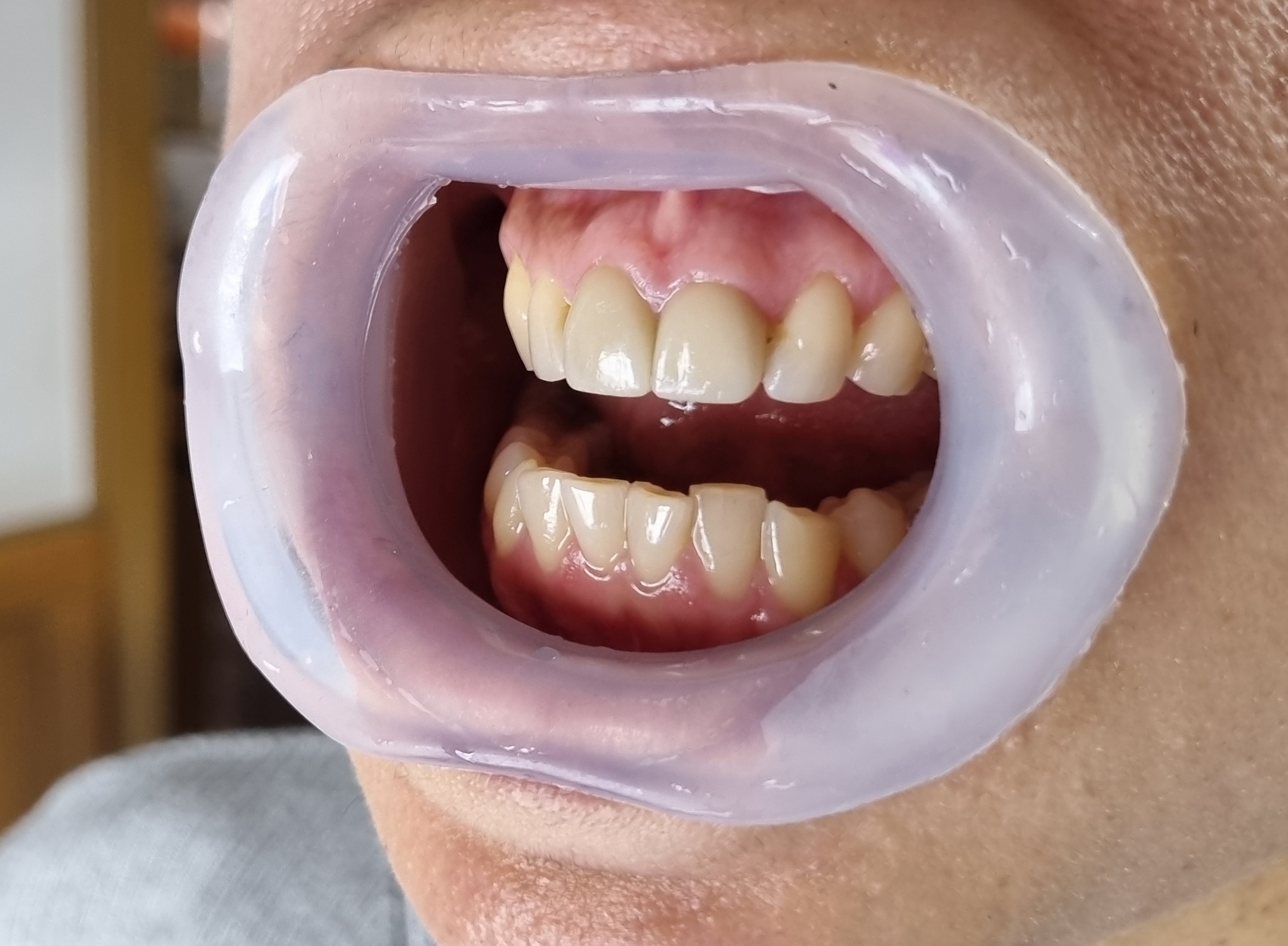 Julldent 144 Insta Retractor - Image 10