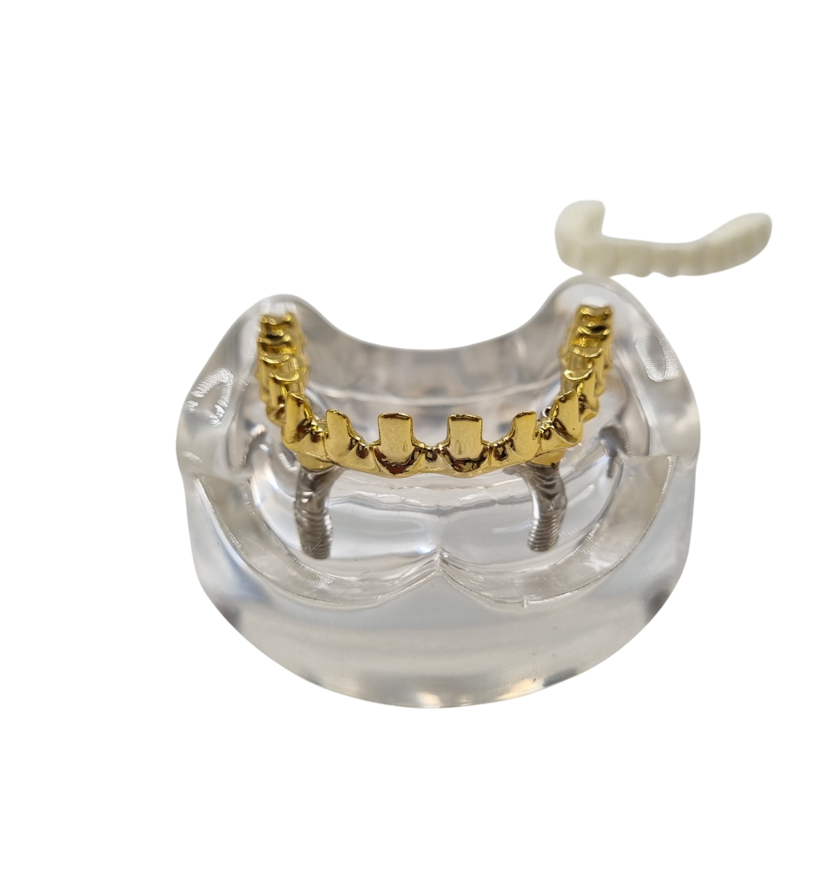 Julldent 181 All on 4 Paulo Malo Model with Prosthesis - Image 4