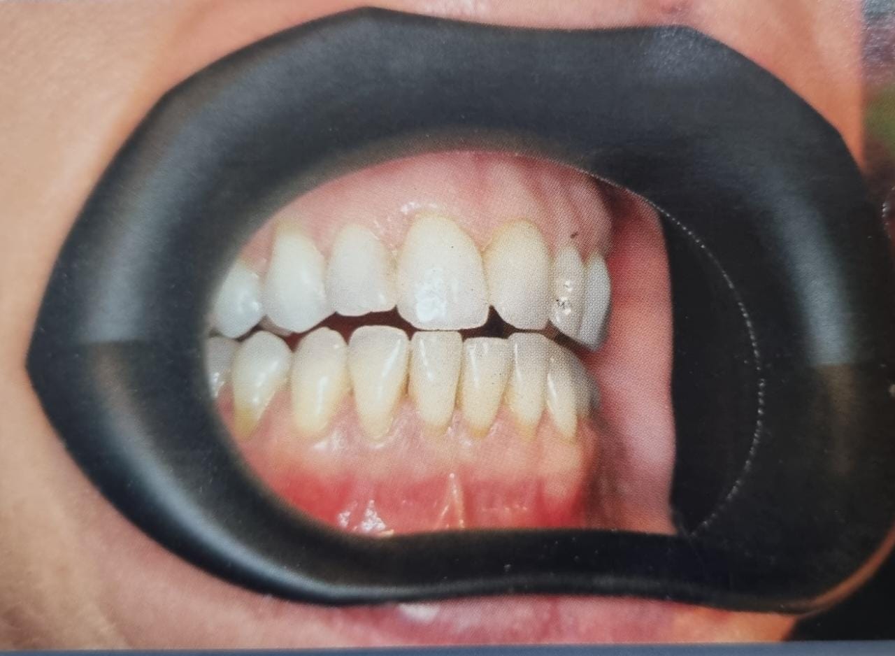 Julldent 144 Insta Retractor