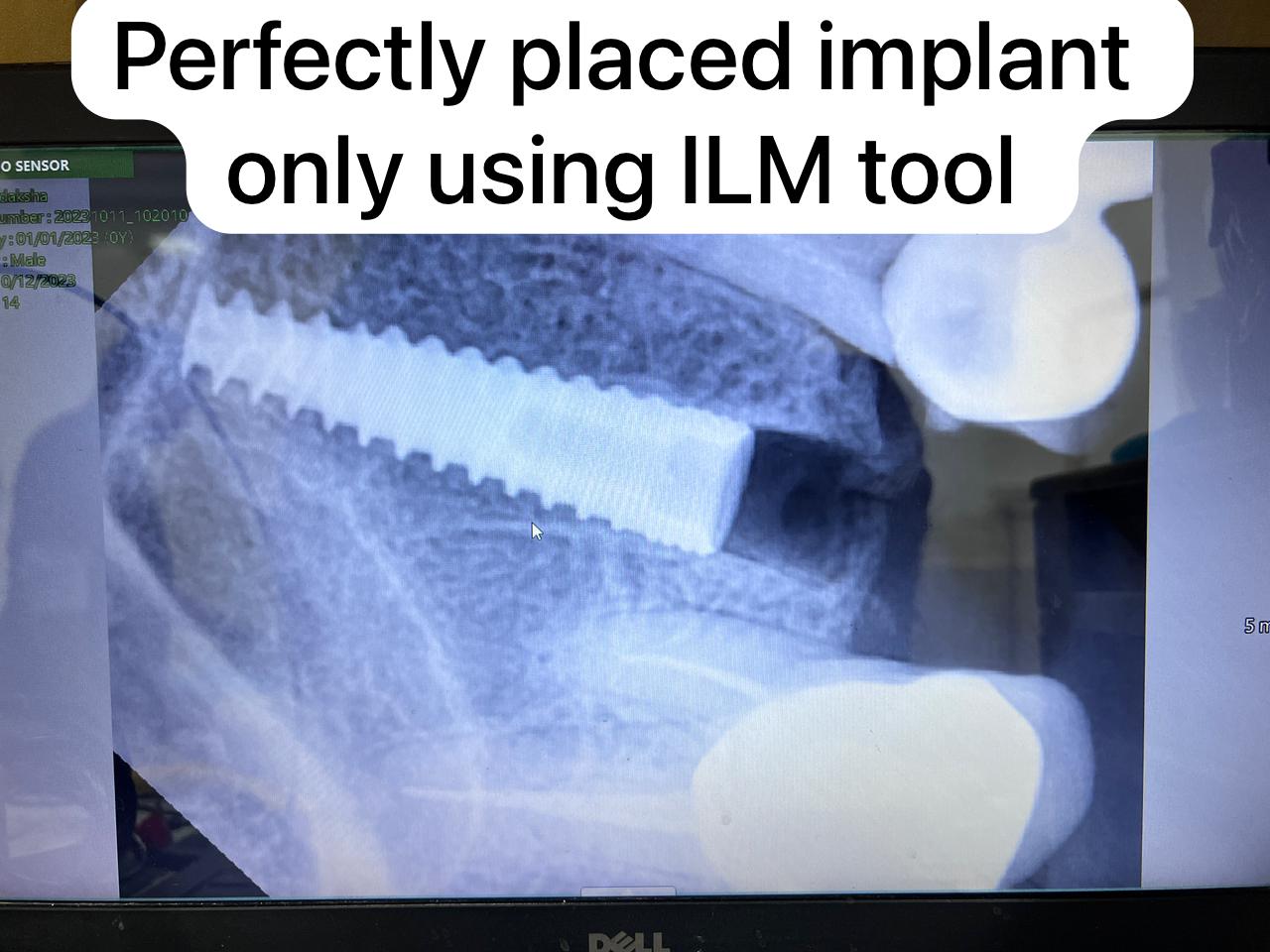 Julldent 169 Pterygoid Path Finder ILM Tool - Image 9