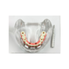 Julldent 202 All on 6 model with pink gingiva