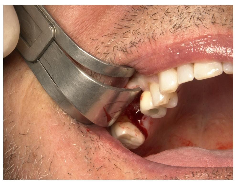 Julldent 177 Dual Cheek & Flap Retractor 1.0 - Image 2