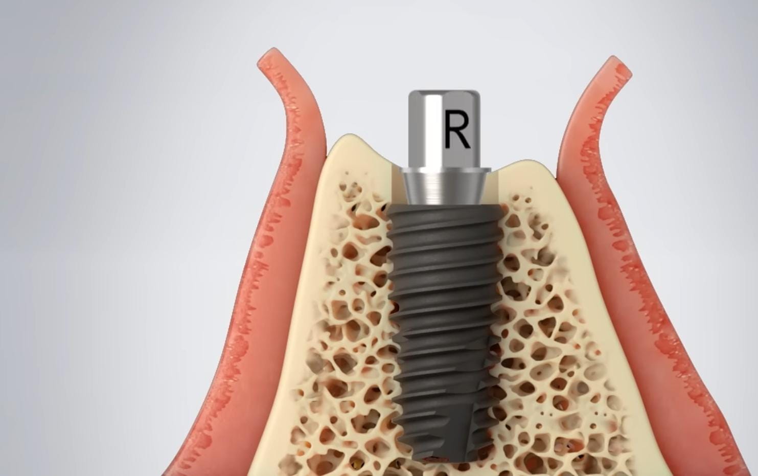 Julldent 016 Profile Drill 6mm - Image 4