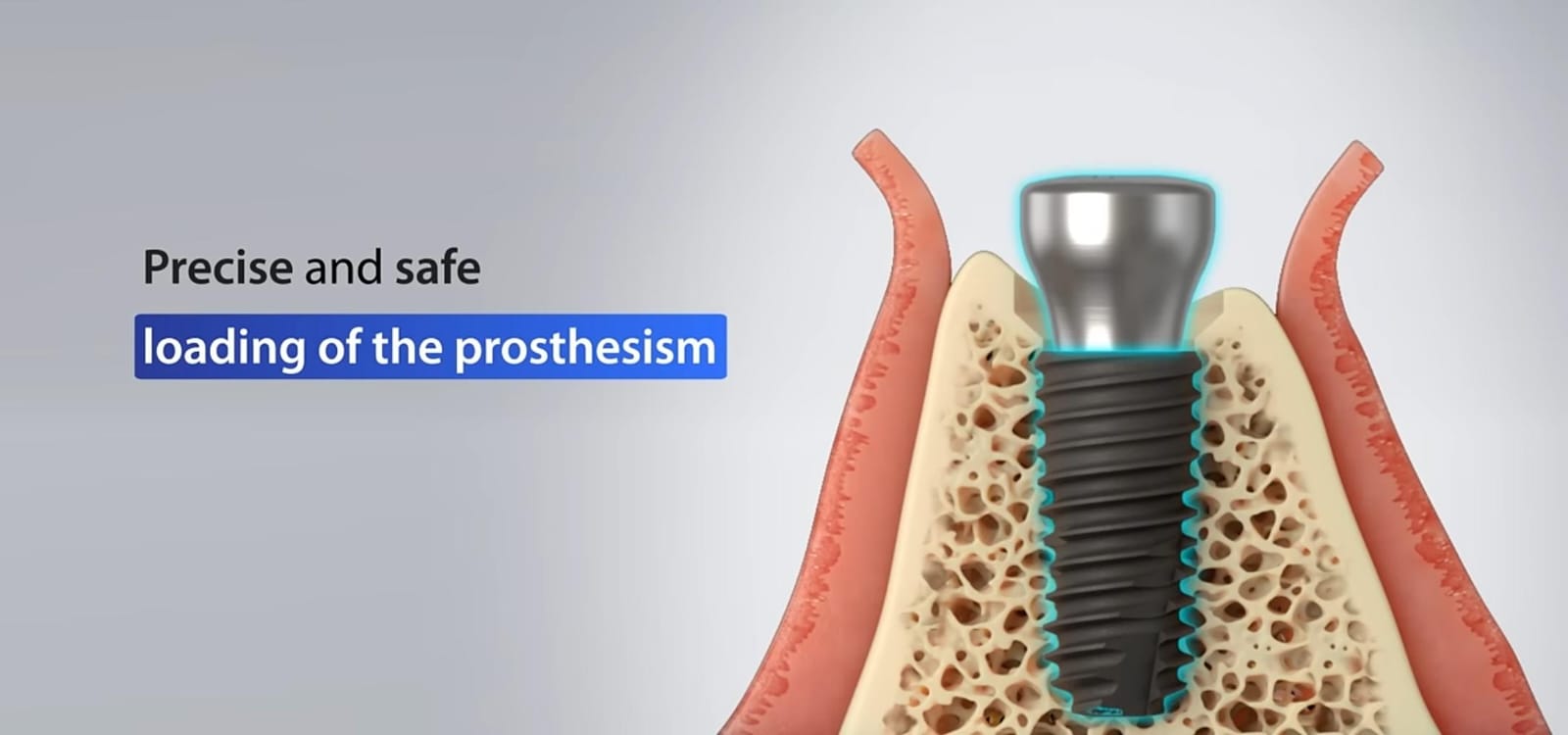 Julldent 016 Profile Drill 6mm - Image 8