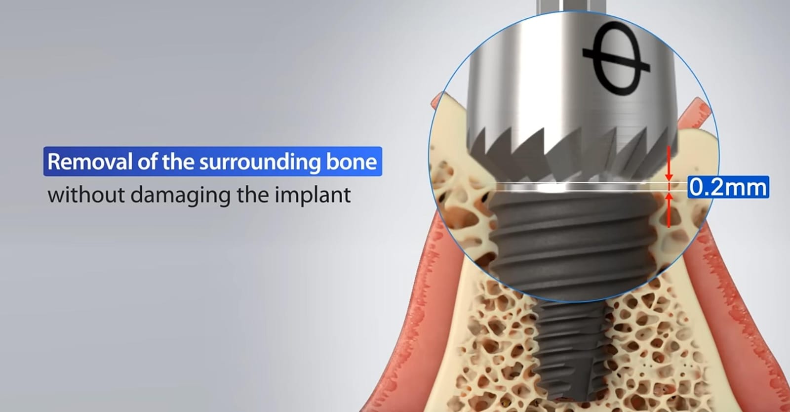 Julldent 016 Profile Drill 6mm - Image 7