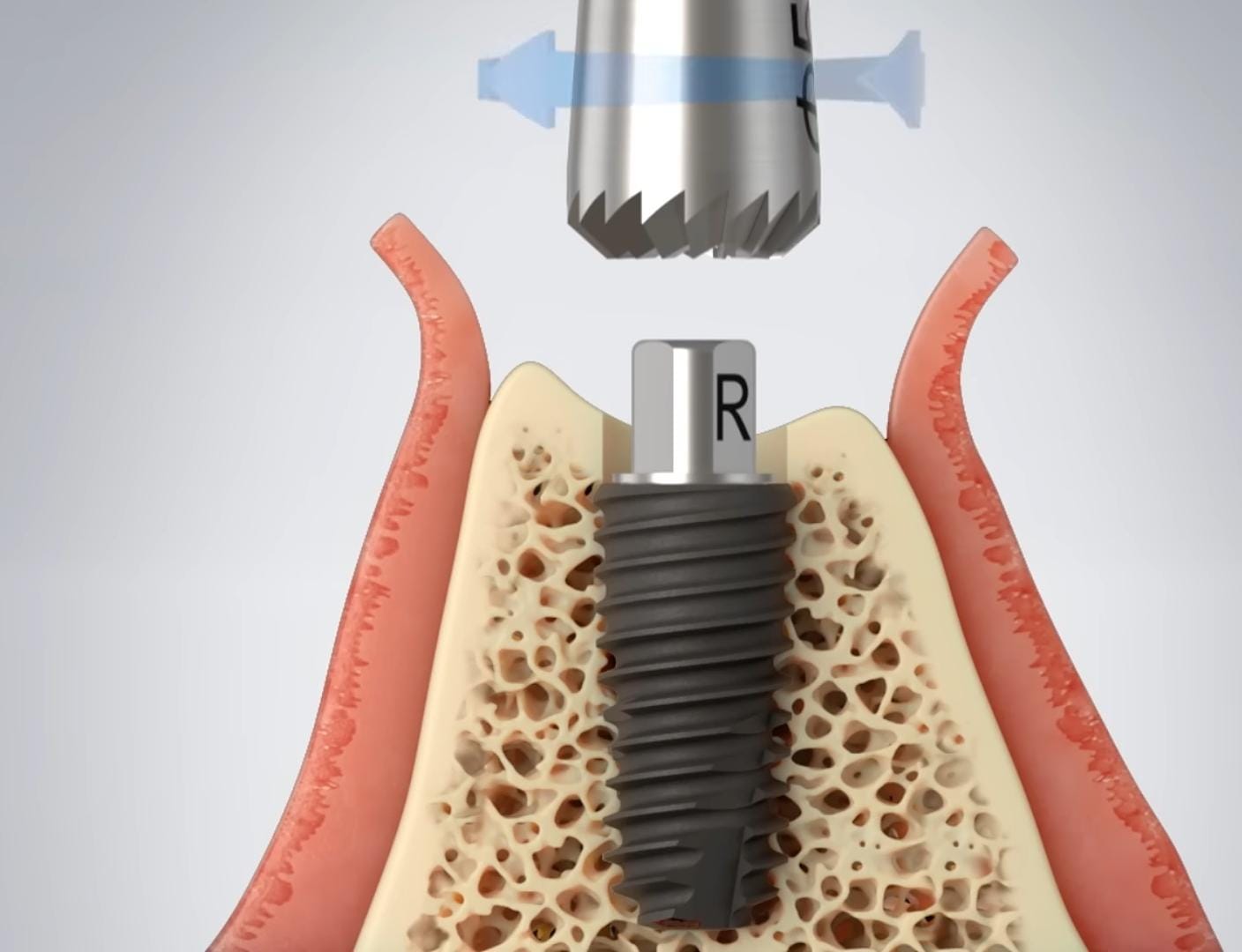 Julldent 016 Profile Drill 6mm - Image 5