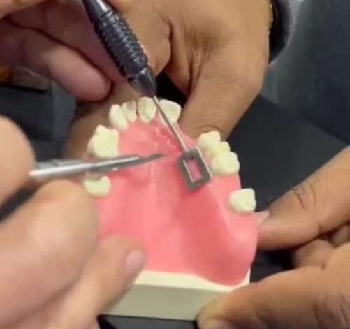 Julldent 184 Gingival Tunnelling Template - Image 3