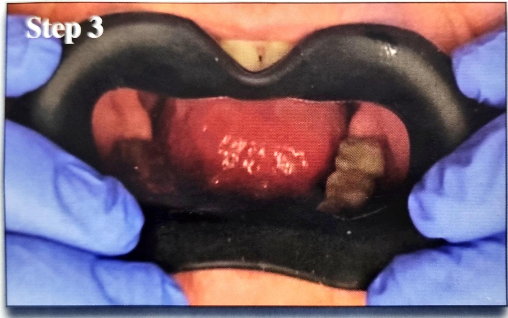 Julldent 144 Insta Retractor - Image 7