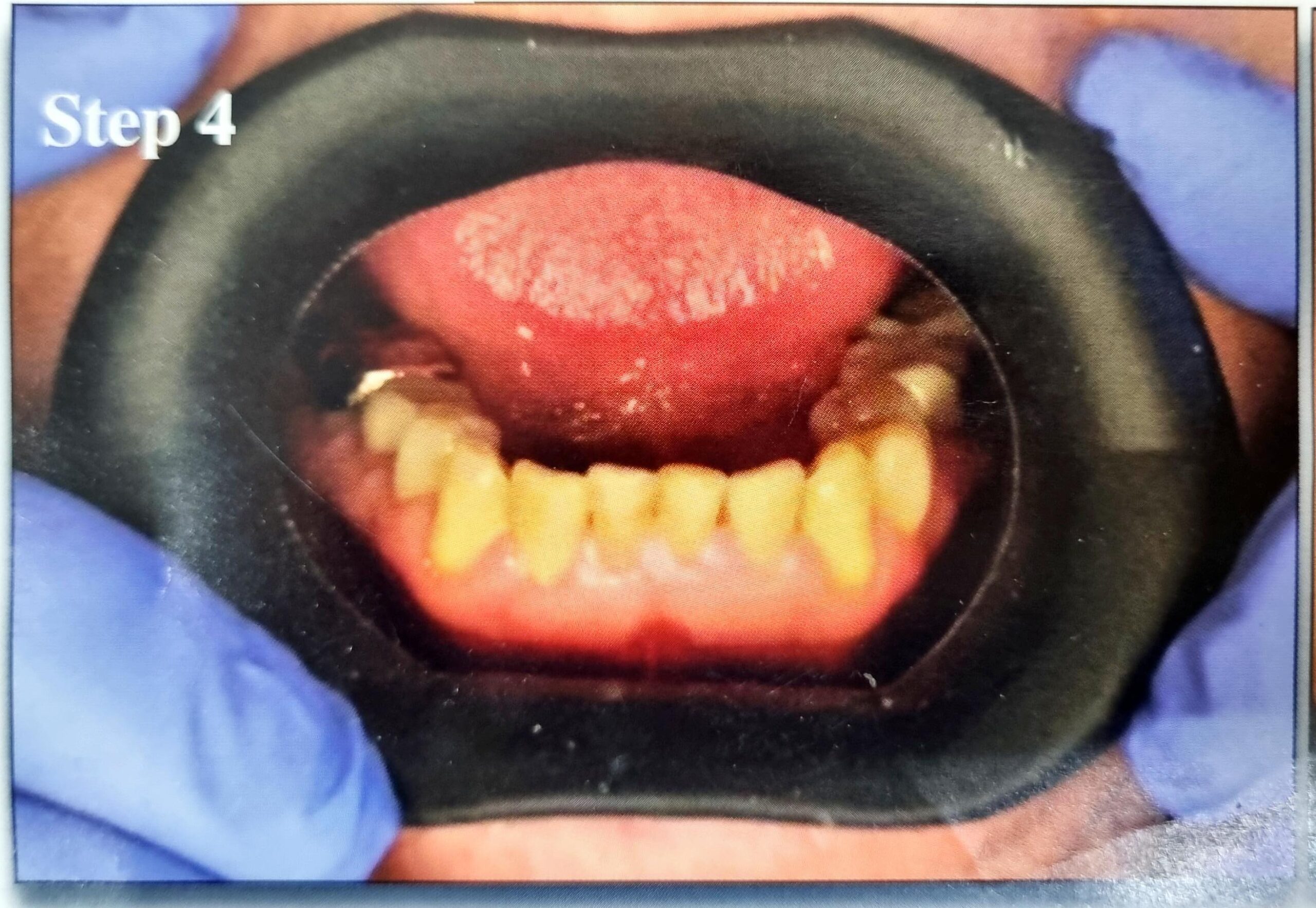 Julldent 144 Insta Retractor - Image 8