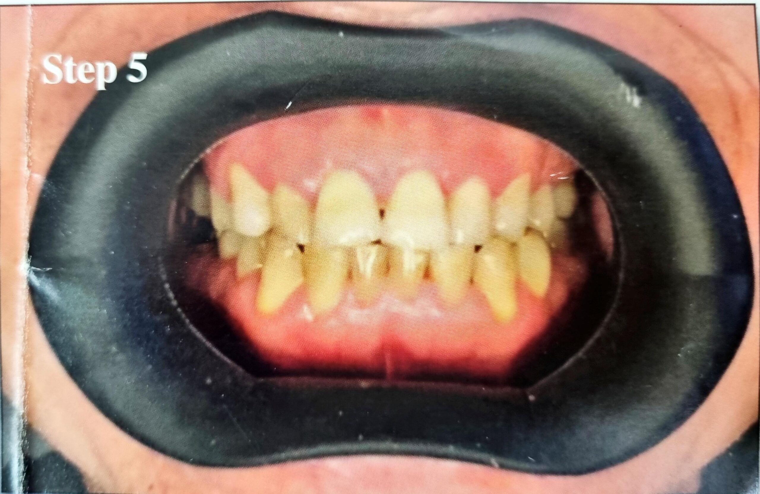 Julldent 144 Insta Retractor - Image 9