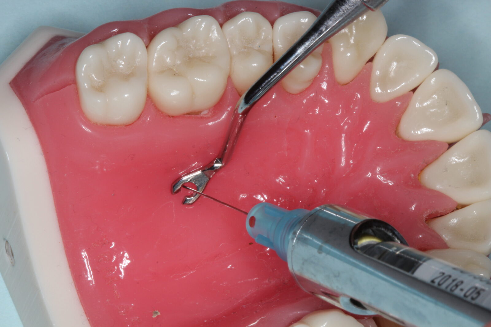 Julldent 231 Palatal Anesthesia Tool (PAT) - Image 3