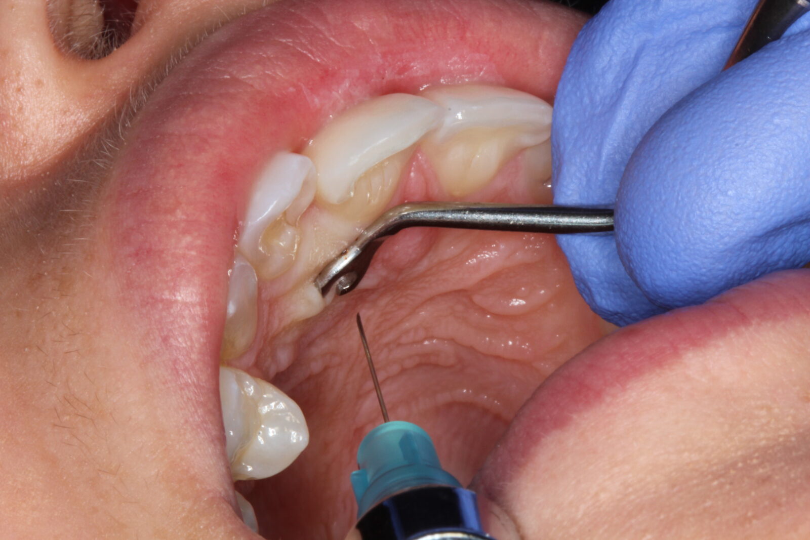 Julldent 231 Palatal Anesthesia Tool (PAT) - Image 4