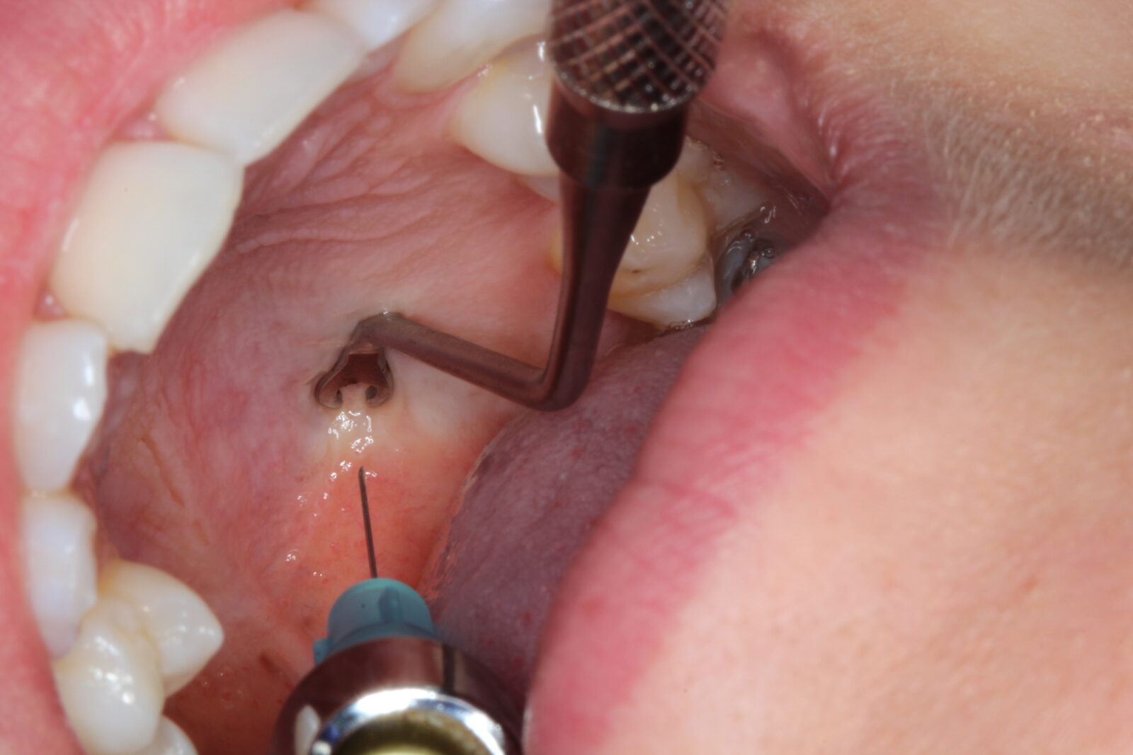 Julldent 231 Palatal Anesthesia Tool (PAT) - Image 5