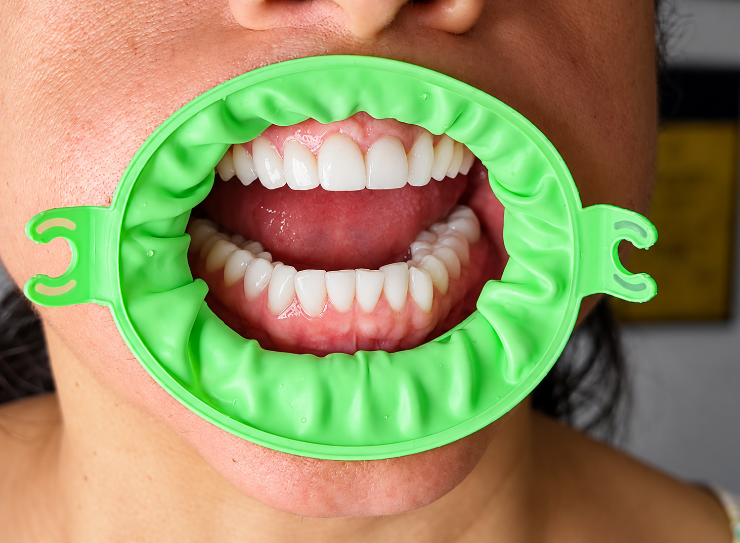 JullDent 249 Flexi-Ring Autoclavable Retractor - Image 8
