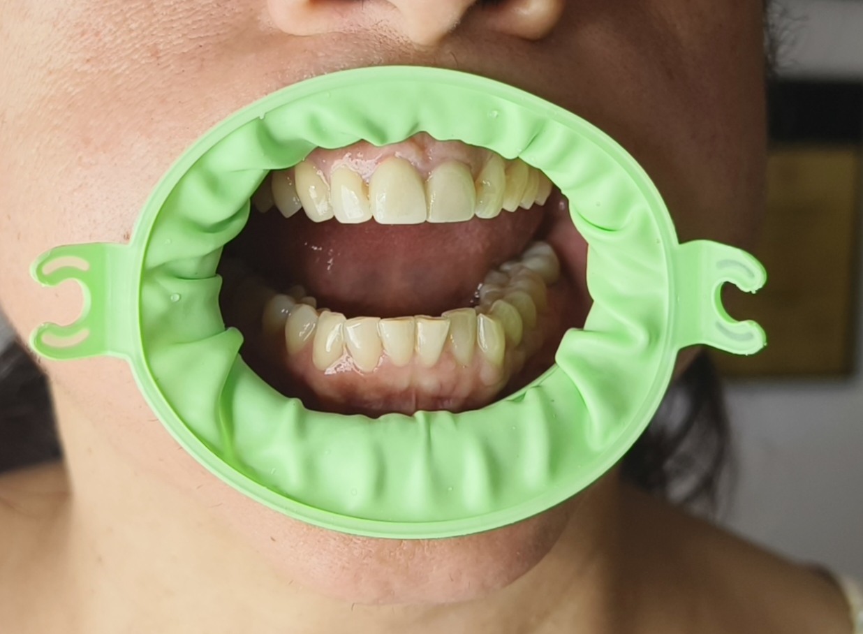 JullDent 249 Flexi-Ring Autoclavable Retractor - Image 11