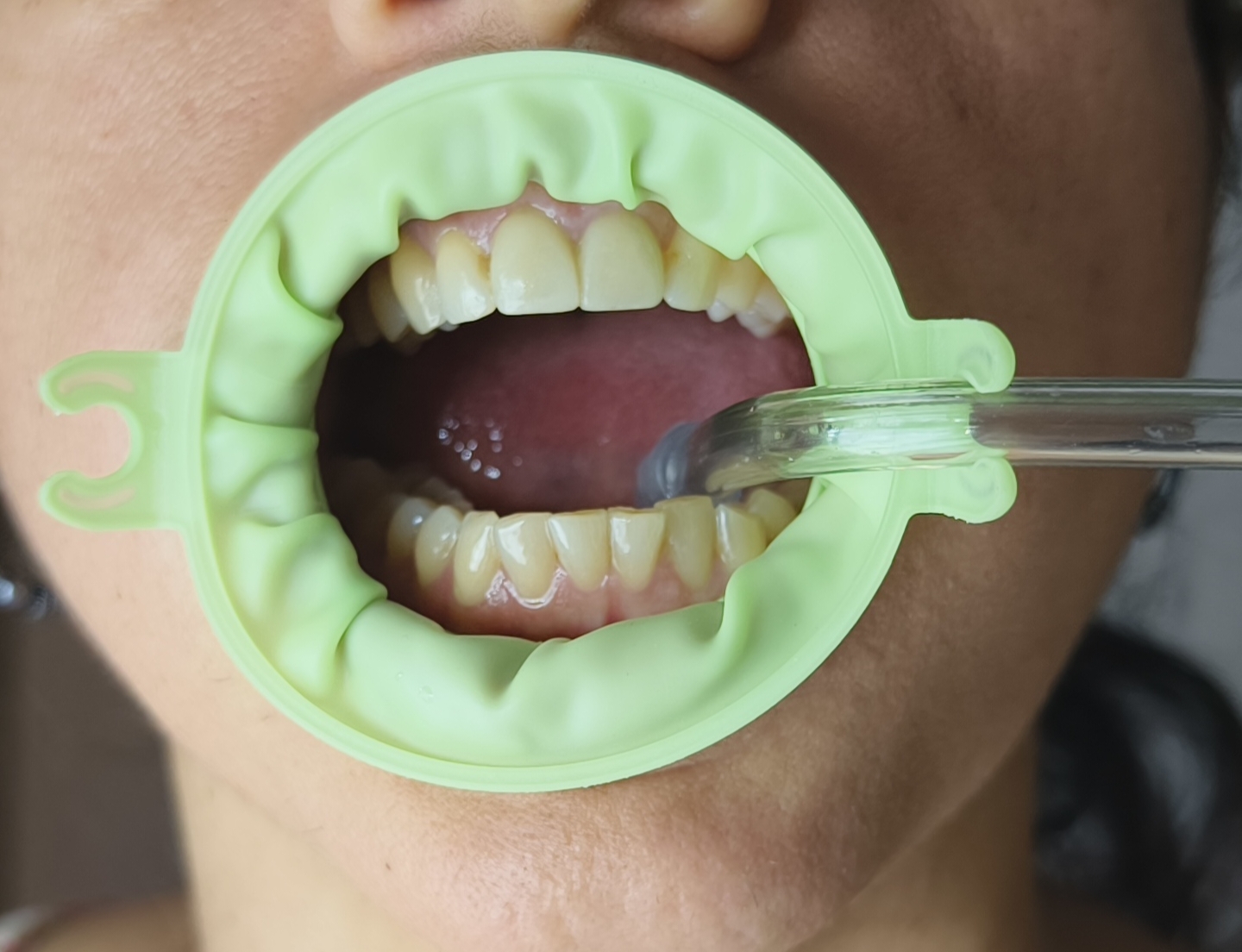 JullDent 249 Flexi-Ring Autoclavable Retractor - Image 9