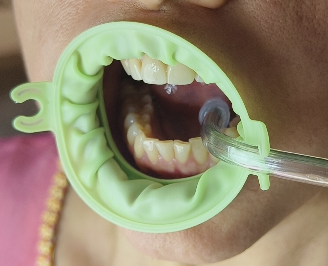JullDent 249 Flexi-Ring Autoclavable Retractor - Image 12
