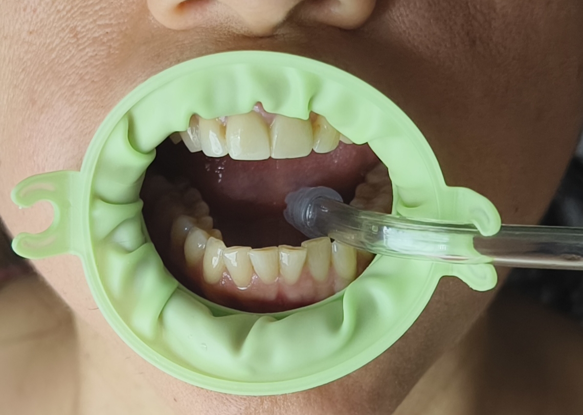 JullDent 249 Flexi-Ring Autoclavable Retractor - Image 2