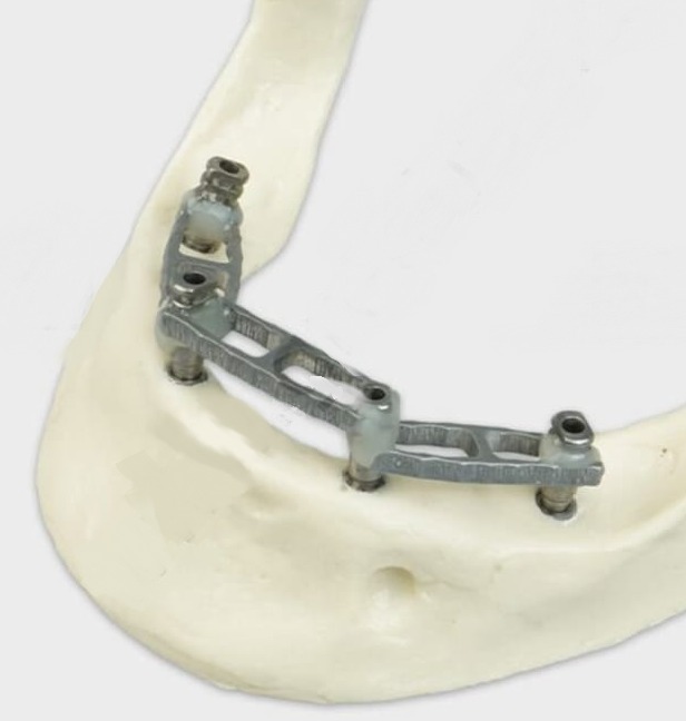 JullDent 251 Jig Ladder Clips (Set of 9 clips) - Image 7